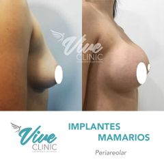 Implantes mamarios