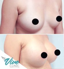Aumento mamario - Viveclinic