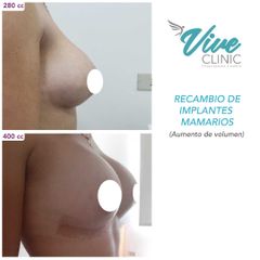 Aumento mamario - Viveclinic