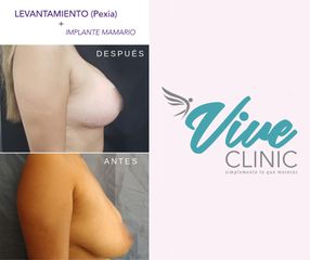 Aumento mamario - Viveclinic