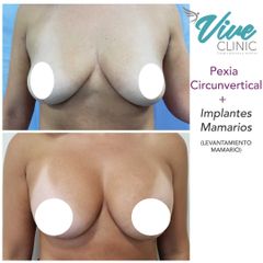 Aumento mamario - Viveclinic