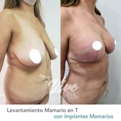 Mastopexia - Viveclinic