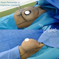 Mastopexia - Viveclinic