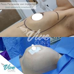 Mastopexia - Viveclinic