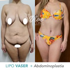 Lipovaser + abdomino - Viveclinic