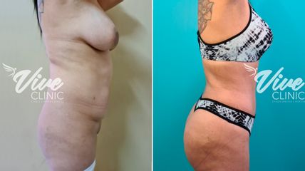 Abdominoplastia - Viveclinic