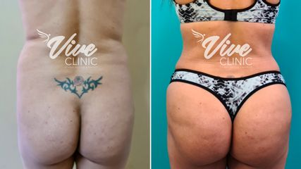 Aumento glúteos - Viveclinic