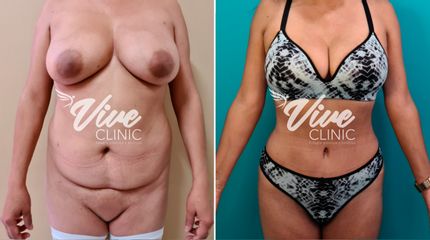 Abdominoplastia - Viveclinic