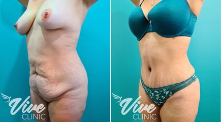 Abdominoplastia - Viveclinic