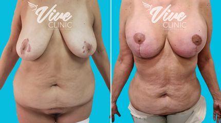 Reducción mamaria - Viveclinic