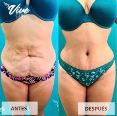 Abdominoplastia - Viveclinic