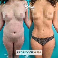 Liposucción - Viveclinic