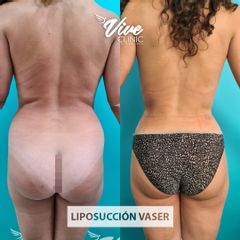 Liposucción - Viveclinic