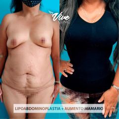 Lipoabdomindoplastia - Viveclinic