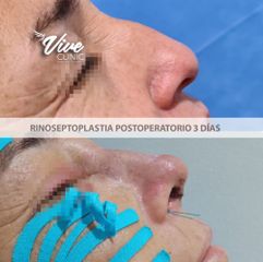 Rinoseptoplastia - Viveclinic