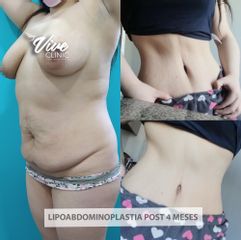 Lipoabdominoplastia - Viveclinic