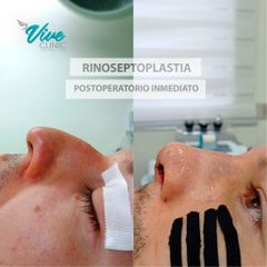 Rinoseptoplastia - Viveclinic