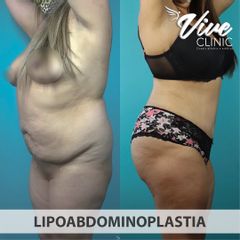 Lipoabdomindoplastia - Vive Clinic