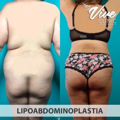 Lipoabdomindoplastia - Vive Clinic