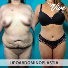 Lipoabdomindoplastia - Vive Clinic