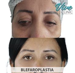Blefaroplastia - Vive Clinic