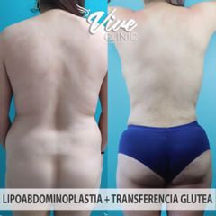 Lipoabdomindoplastia - Vive Clinic