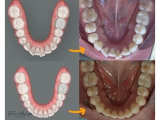Alineadores dentales - Clínica Ortodontik