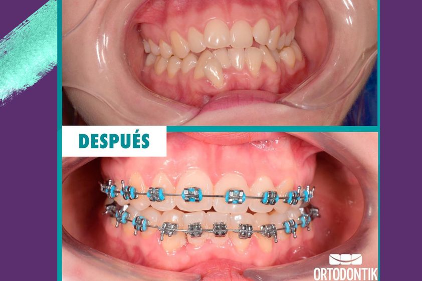 Ortodoncia antes y después - 854184