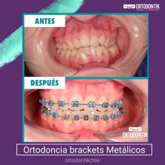Brackets metálicos - Clínica Ortodontik