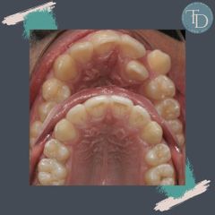 Frenillos metálicos de ortodoncia - Clínica Ortodontik
