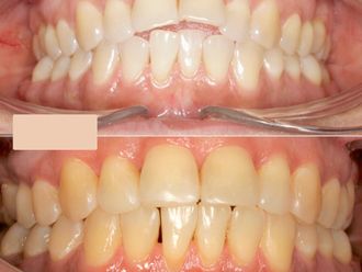 Ortodoncia invisible antes y después - 866494