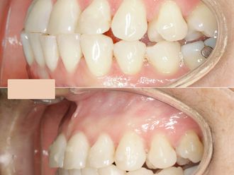 Ortodoncia invisible antes y después - 866495