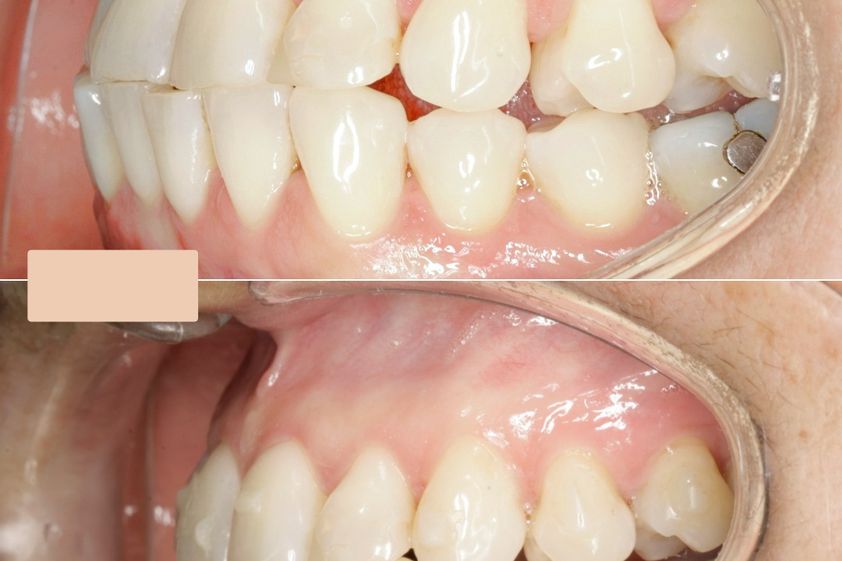 Ortodoncia invisible antes y después - 866495