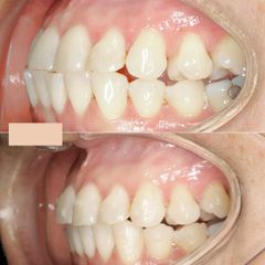 Invisalign - Clínica Ortodontik