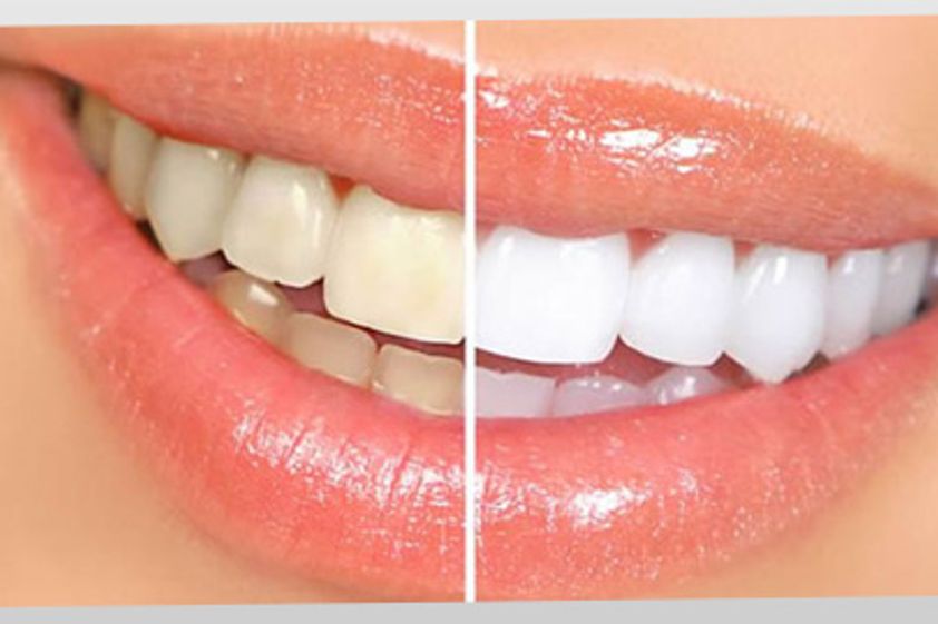 Blanquear dientes antes y después - 426042