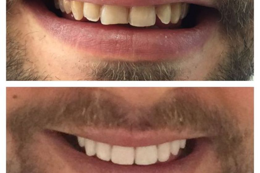 Carillas dentales antes y después - 569479