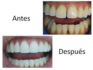 Caso de diseño de sonrisa con carillas.