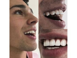 Blanquear dientes-595680