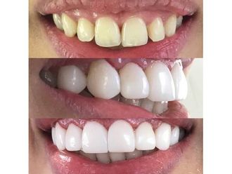 Blanquear dientes-595682