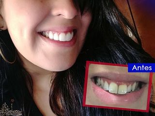 Antes y después reconstrucción dental