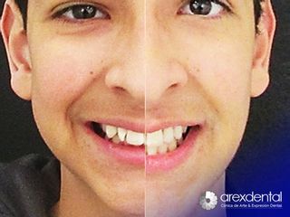 Antes y después ortodoncia