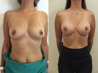Antes y despues de aumento de mamario