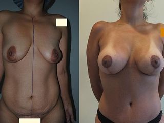 Antes y despues de mastopexia