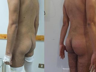 Antes y despues de protesis de gluteos