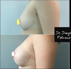 Aumento de mamas - Dr. Diego Polanco