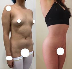 Liposucción - Dr. Diego Polanco