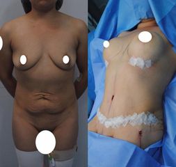 Lipoescultura - Dr. Diego Polanco
