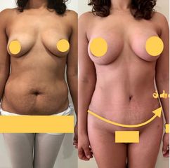Abdominoplastia - Dr. Diego Polanco