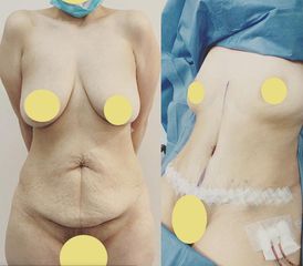 Abdominoplastia - Dr. Diego Polanco