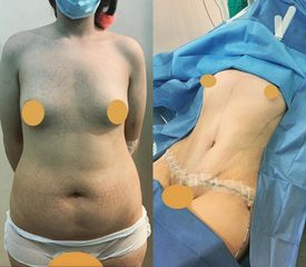 Abdominoplastia - Dr. Diego Polanco
